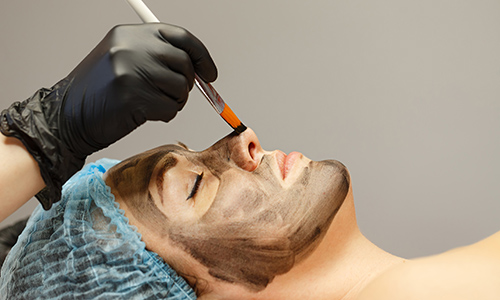 Carbon Laser Peel